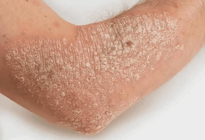 Actinic keratosis and squamous cell carcinoma treatment showing field therapy
