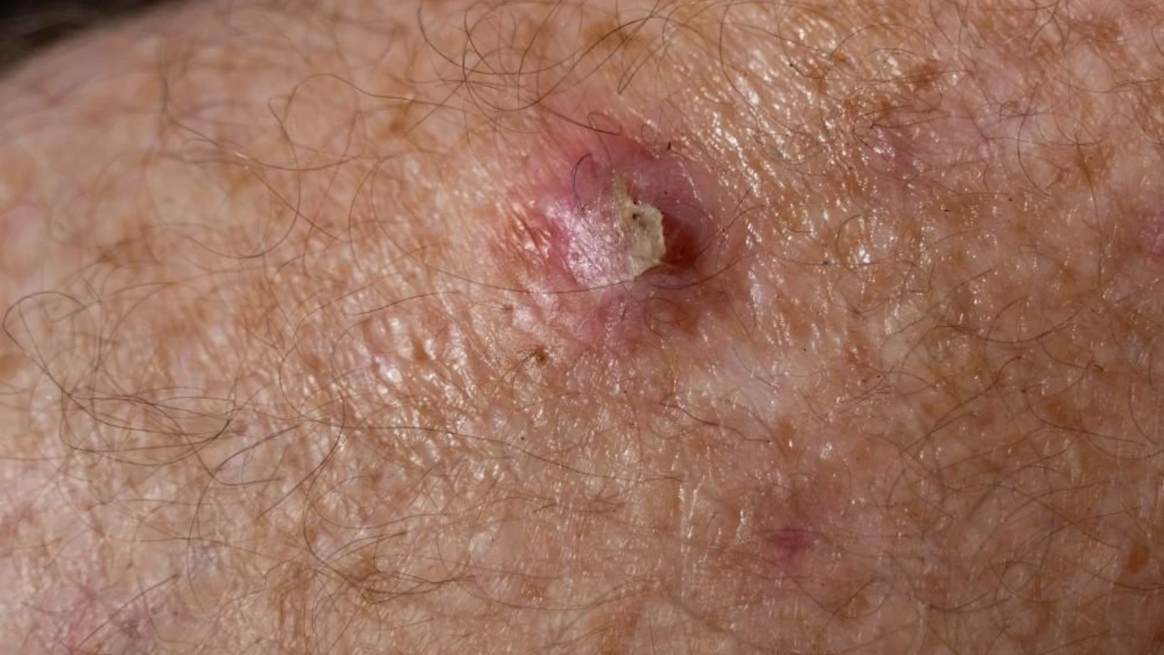 Squamous cell carcinoma skin lesion showing scaly keratinized surface