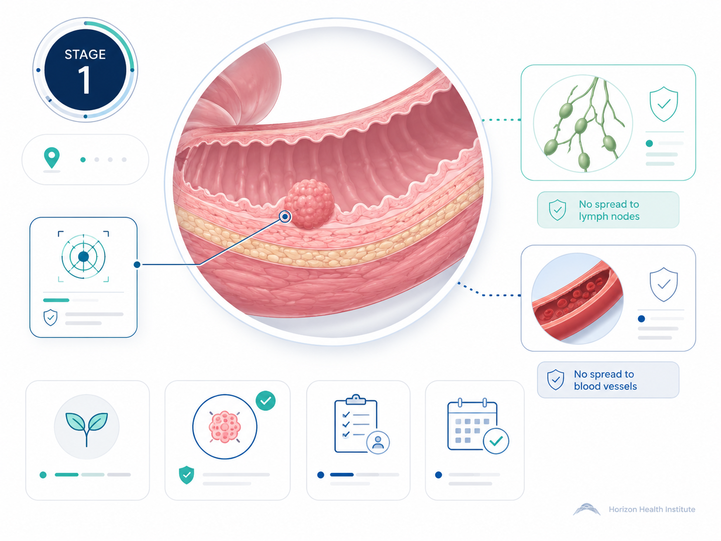 stage 1 cancer guide survival rates