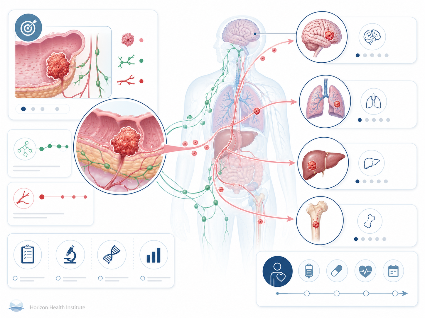 stage 4 cancer guide survival rates