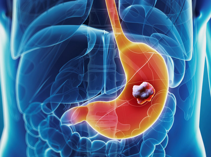 stomach cancer — gastric tumor in the stomach lining causing weight loss, abdominal pain, and upper GI bleeding