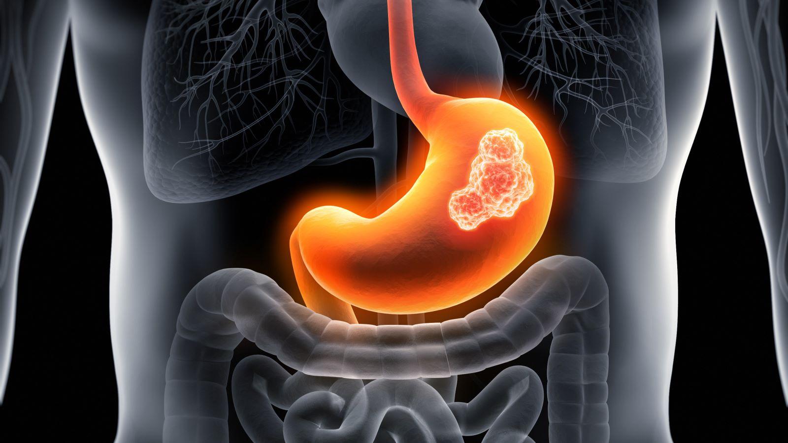 stomach cancer symptoms — weight loss, abdominal pain, vomiting blood, and loss of appetite as warning signs of gastric cancer