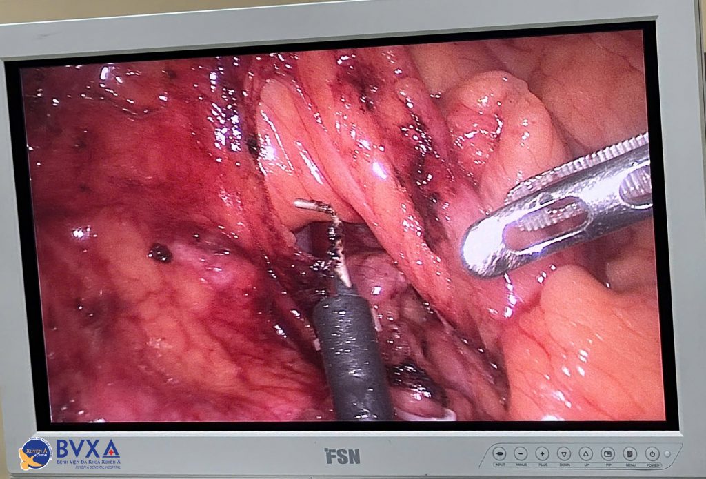 Stool sample collection for FIT colon cancer screening test