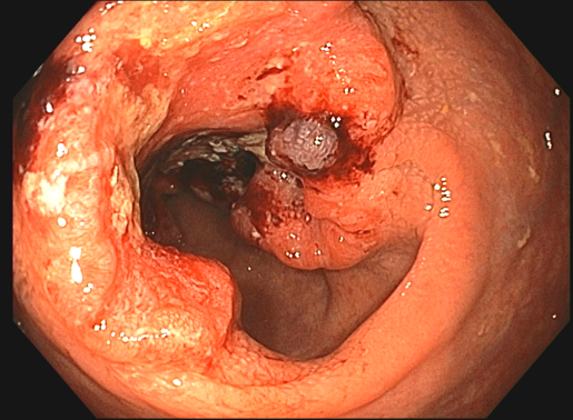 FIT stool test kit for colon cancer screening at home
