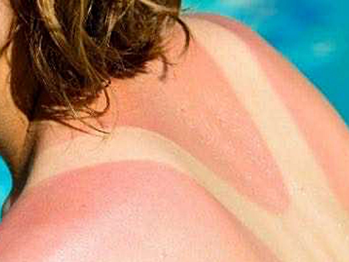 Sun exposure skin cancer risk showing UV radiation damage to skin