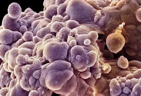 cancer blood test tumor markers monitoring during treatment