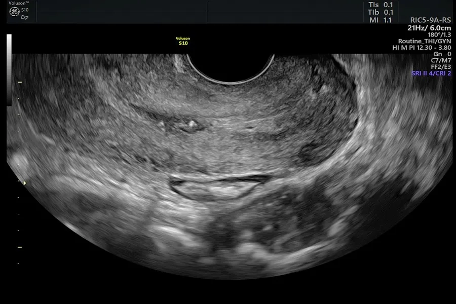 Ultrasound for cancer showing thyroid nodule evaluation with ACR TI-RADS scoring for biopsy decision