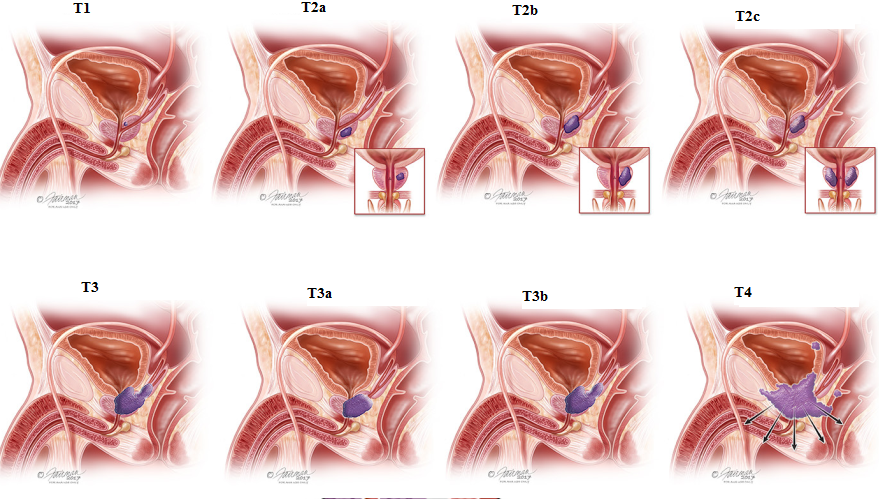 diagram of lower urinary tract symptoms LUTS storage and voiding categories in men