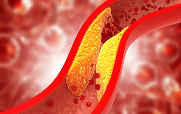Diagram showing atherosclerosis plaque buildup narrowing an artery causing reduced blood flow