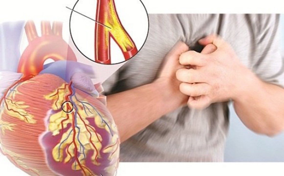 Medical illustration of the heart showing coronary arteries affected by coronary artery disease and plaque buildup