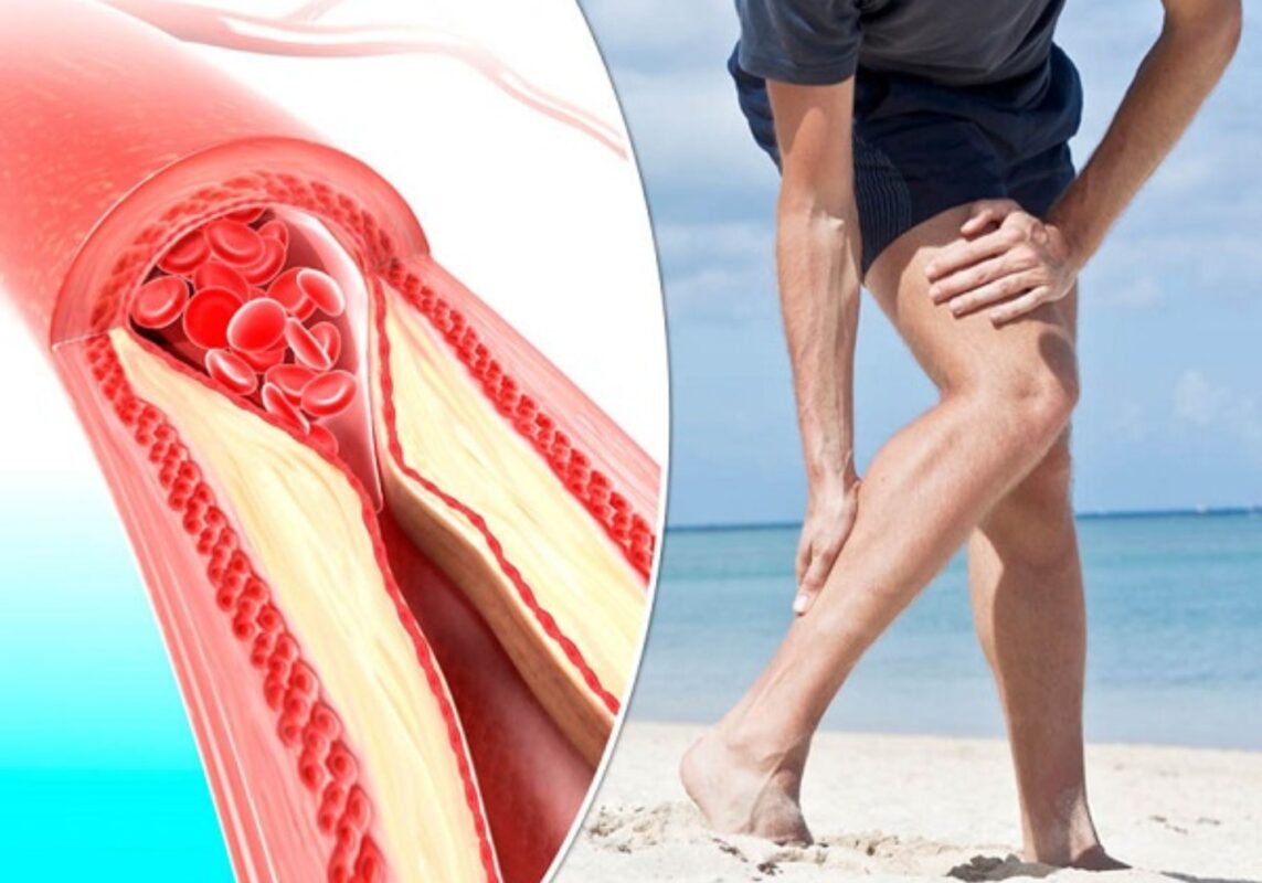 Medical illustration showing peripheral artery disease affecting blood vessels in the leg with atherosclerotic plaque narrowing