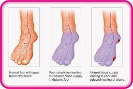 Illustration showing poor circulation in legs and feet with reduced blood flow through narrowed arteries