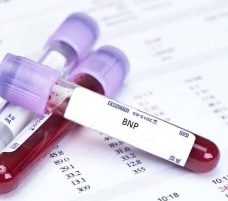 BNP blood test heart failure natriuretic peptide NT-proBNP dyspnea diagnosis volume overload ventricular wall stress biomarker