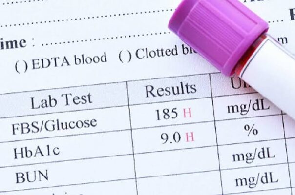 A1C testing schedule diabetes — lab technician analyzing HbA1c blood sample showing glycated hemoglobin percentage for diabetes monitoring