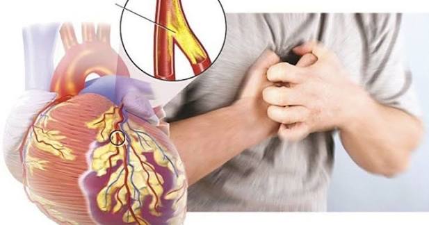 Nitroglycerin sublingual tablet or spray for acute angina relief and coronary vasodilation