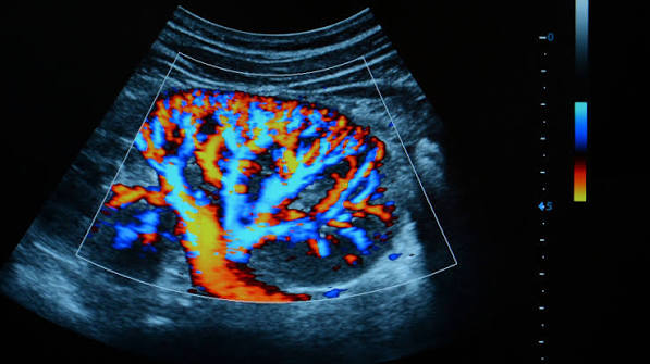 Angiogram procedure recovery radial access PCI stent CABG risks contrast allergy kidney function aftercare