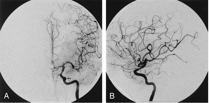 Angiogram what patients should know coronary angiography catheterization contrast dye arteries blockage diagnosis