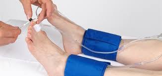 Ankle-brachial index test ABI peripheral arterial disease PAD blood pressure cuffs Doppler measurement leg circulation screening