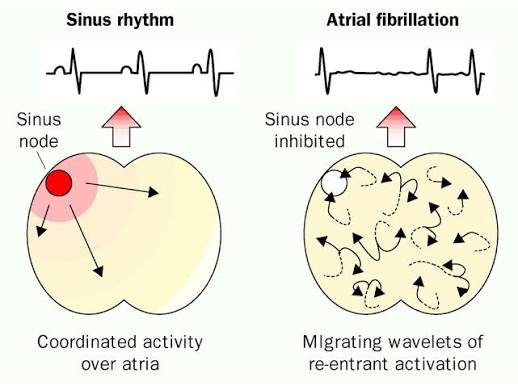 Atrial fibrillation stroke risk left atrial appendage thrombus formation echocardiogram
