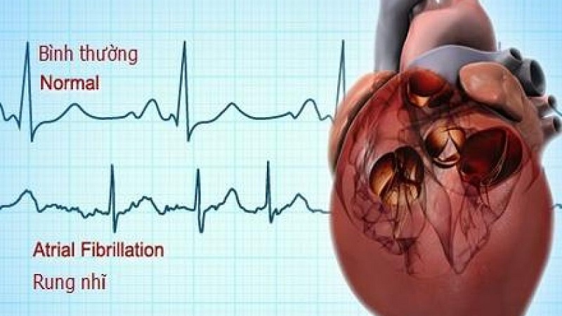 Atrial fibrillation symptoms showing irregular heartbeat pattern on ECG rhythm strip