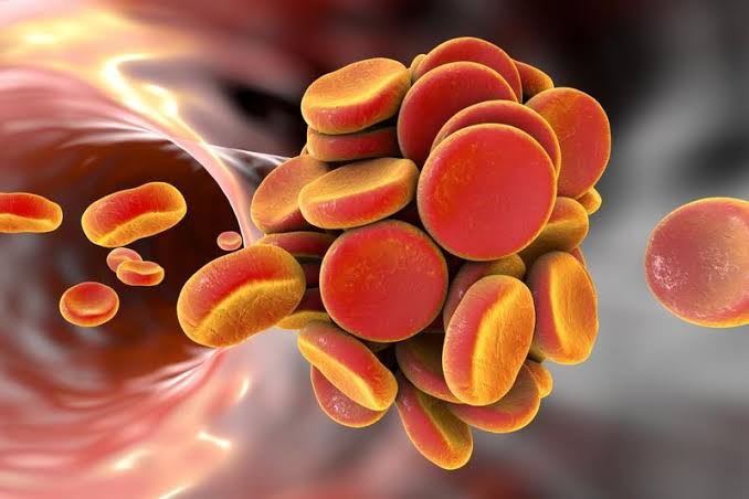 Blood clot risk factors Virchow triad hypercoagulability venous stasis endothelial injury thrombosis prevention
