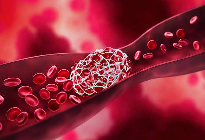Blood clots warning signs deep vein thrombosis leg swelling pulmonary embolism chest pain shortness of breath