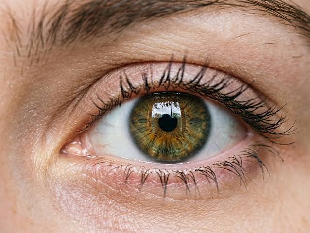blurry vision from high blood sugar caused by osmotic fluid shifts in the lens of the eye