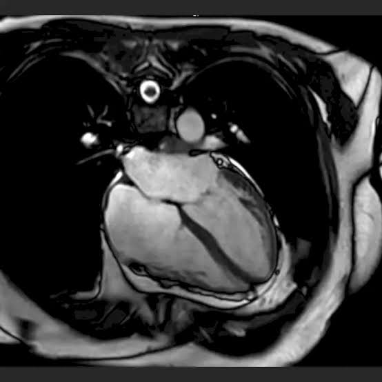 Cardiac MRI when it may be used late gadolinium enhancement myocardial viability cardiomyopathy tissue characterization