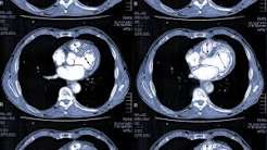 Cardiac CT scan coronary artery calcium score CTCA coronary CT angiography plaque stenosis atherosclerosis imaging