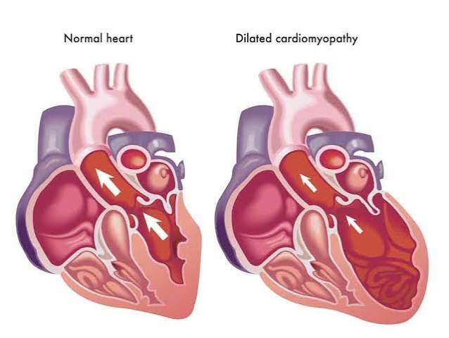 Genetic counseling for cardiomyopathy family screening and inherited heart muscle disease risk assessment