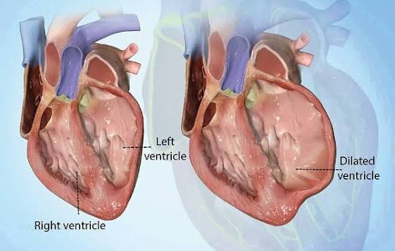 Cardiomyopathy types comparison showing dilated, hypertrophic, and restrictive heart muscle disease patterns