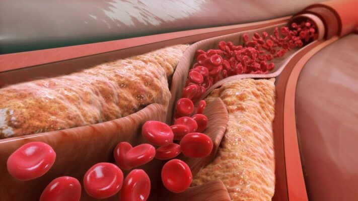 Causes of high cholesterol — genetics diet obesity and medical conditions illustrated