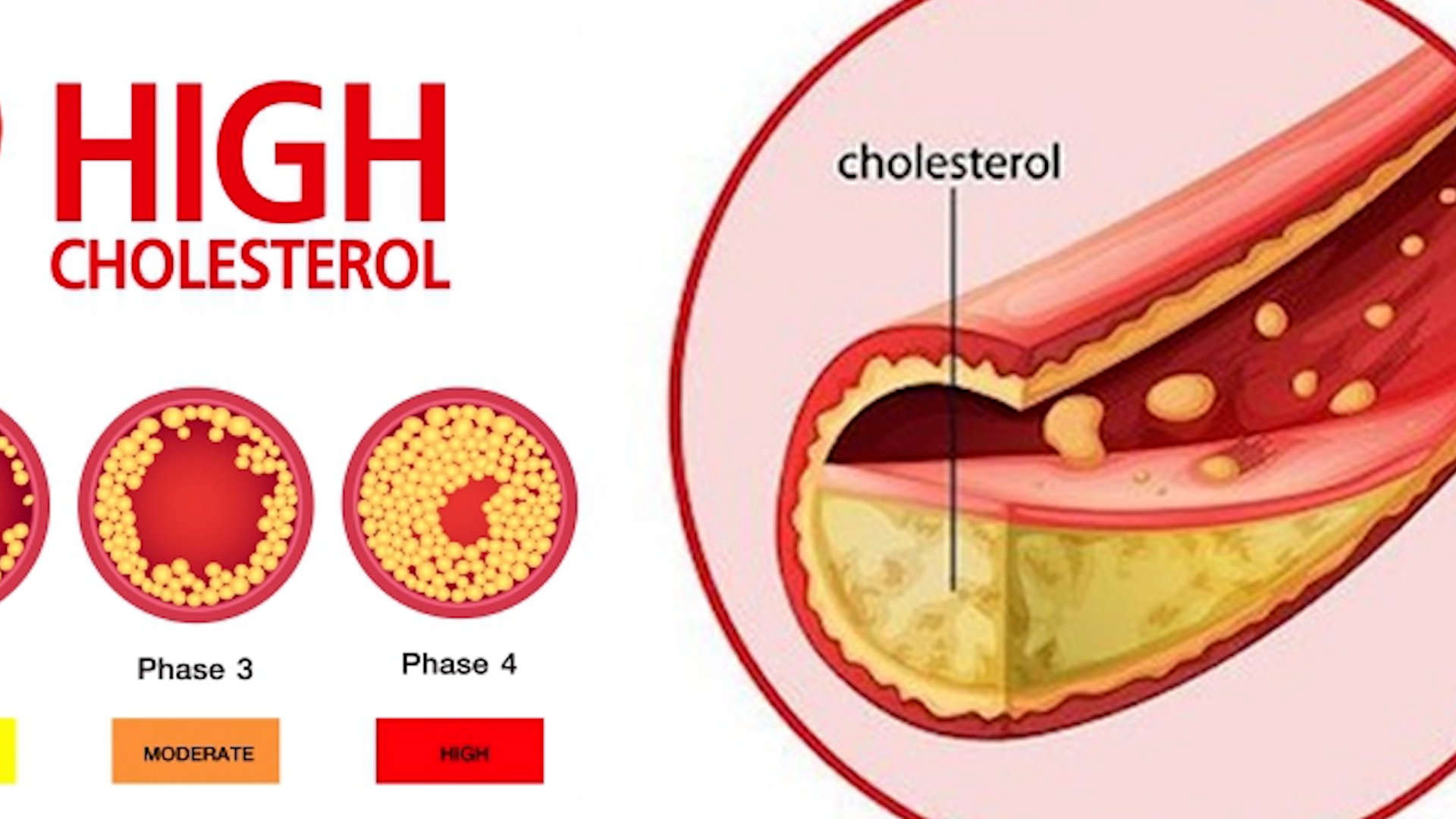 Foods that cause high cholesterol — saturated fat in red meat butter cheese and processed foods