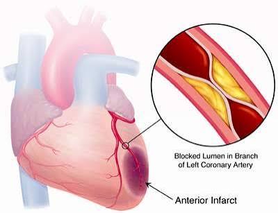 Cholesterol and heart attack risk — elevated LDL and arterial plaque leading to myocardial infarction