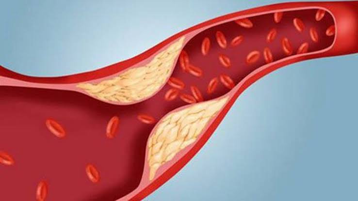 Carotid artery atherosclerosis — plaque narrowing blood flow to the brain increasing stroke risk