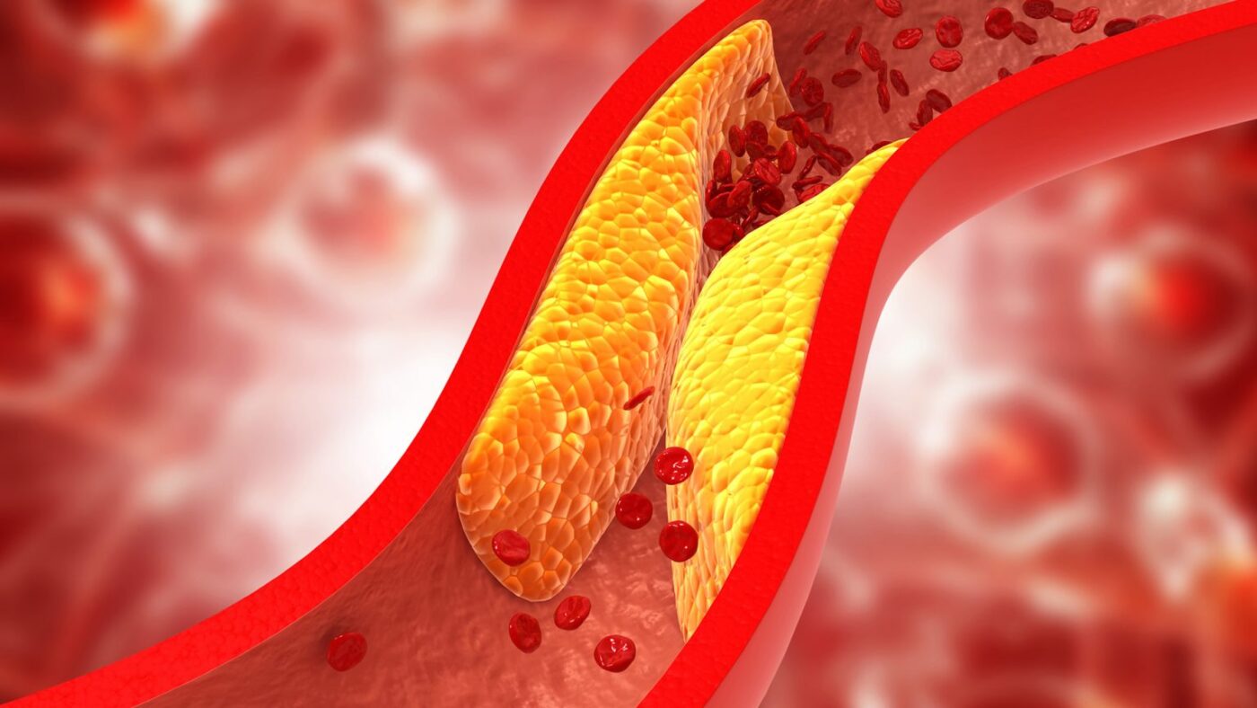 Cholesterol and stroke risk — carotid artery plaque buildup leading to ischemic stroke