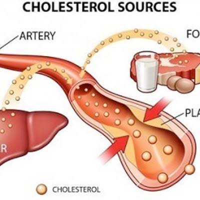 lipid panel diabetes results — laboratory cholesterol report showing LDL HDL triglycerides and total cholesterol values with target ranges for diabetes cardiovascular risk management