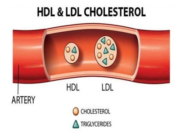 Cholesterol numbers by risk level — medical report showing LDL HDL and triglyceride values alongside a stethoscope