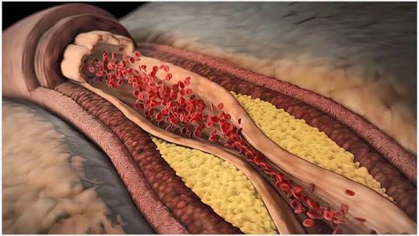 Cholesterol and plaque buildup in arteries — cross-section showing atherosclerotic plaque formation