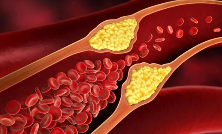 Stages of plaque buildup in arteries — from fatty streak to vulnerable plaque rupture