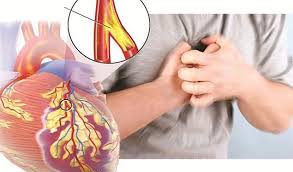 Coronary artery disease diagram showing atherosclerotic plaque buildup narrowing coronary arteries
