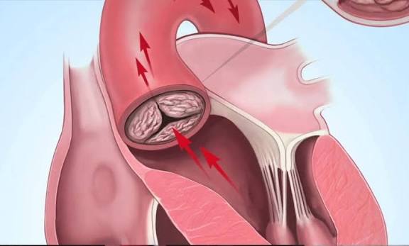 Coronary calcium score what adults should know Agatston score risk categories CAC zero statin therapy decision