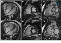 Coronary calcium score zero statin decision MESA study intermediate risk reclassification cardiovascular primary prevention