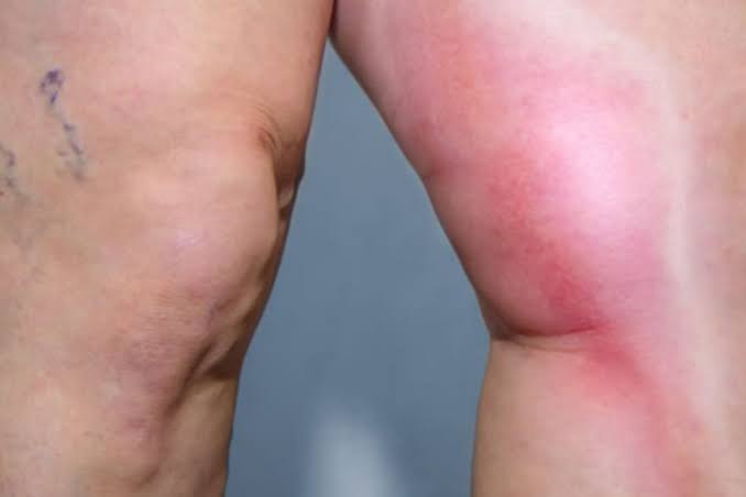 Deep vein thrombosis prevention compression stockings sequential compression device anticoagulation prophylaxis early ambulation