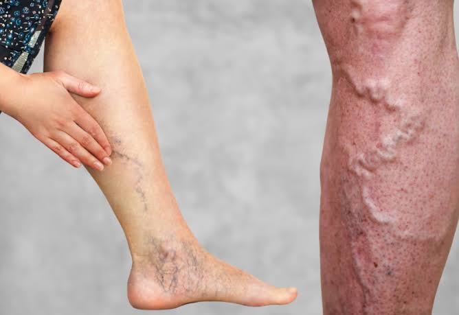 Deep vein thrombosis symptoms unilateral leg swelling calf pain warmth redness popliteal femoral vein clot