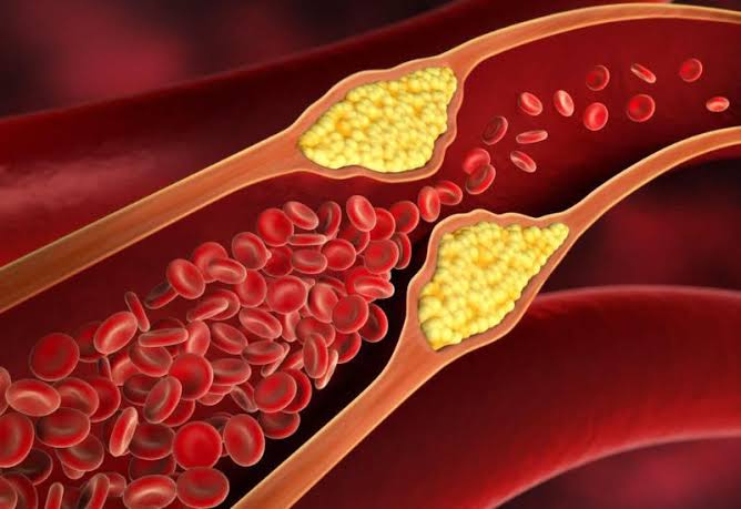 doctor explaining statin therapy and cholesterol management to a patient with type 2 diabetes