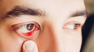 retinal photograph showing proliferative diabetic retinopathy with neovascularization and hemorrhages