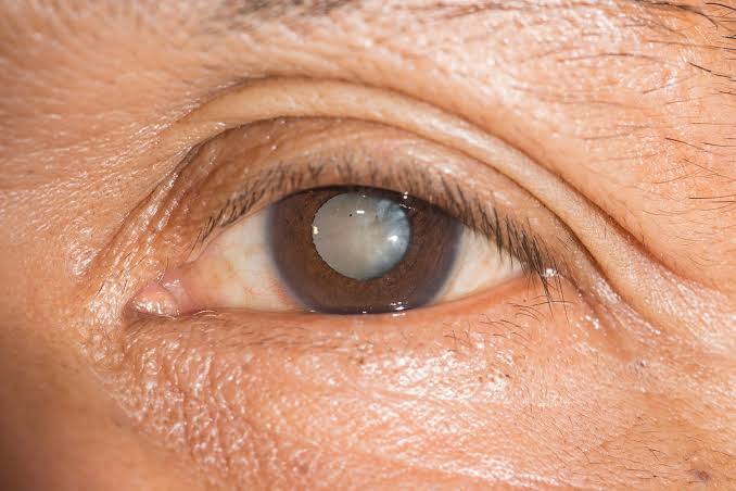 ophthalmologist performing dilated eye exam on a patient with diabetes to screen for diabetic retinopathy