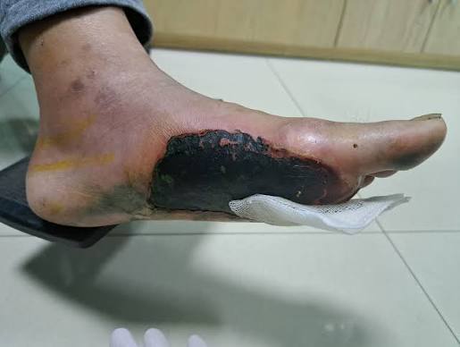 podiatrist examining the feet of a patient with diabetes checking for signs of neuropathy ulcers and circulation problems