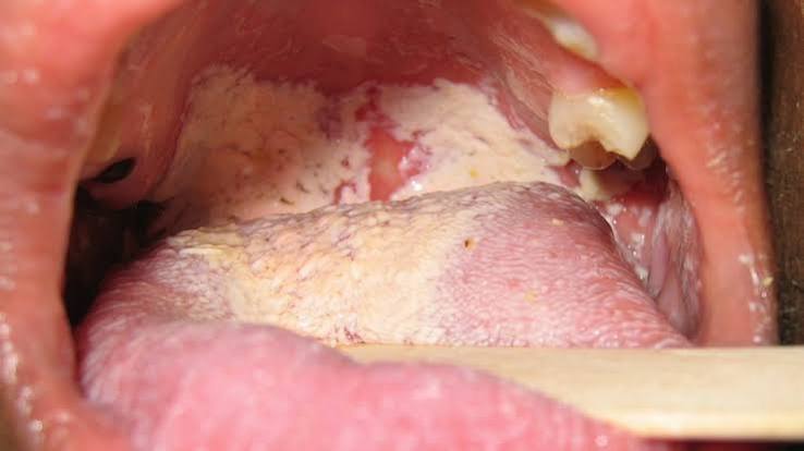 comparison of healthy gums versus advanced periodontal disease with gum recession bone loss and inflammation